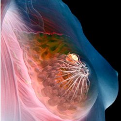 Breast cancer. The yellow mass in the illustration depicts a tumor located in a glandular tissue of the breast.
